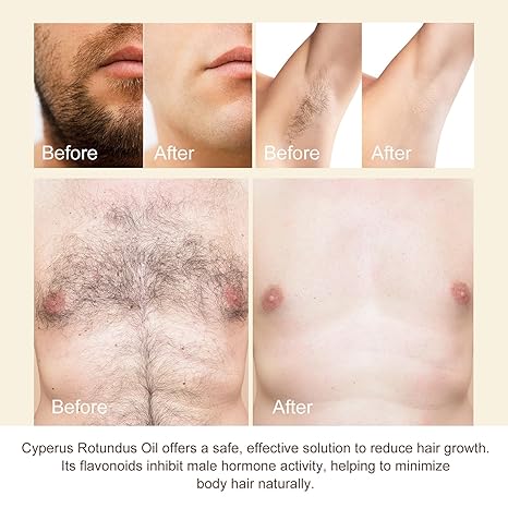 🔥Last Day 50% OFF - 💡Cyperus Rotundus Oil